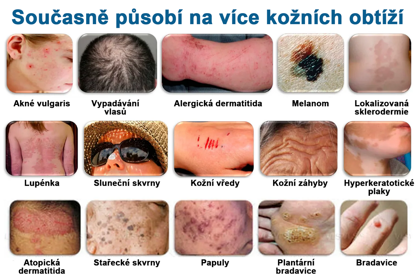 Pureluxo® Fekete Rizses Bőrregeneráló Krém 👨‍⚕️ (Szemölcsök, bőrkinövések, foltok és hiperpigmentáció kezelésére)