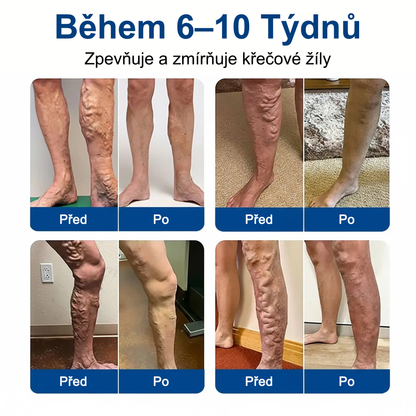 FLORISMA® Klinická mikrojehličková náplast s diosminem a hesperidinem🌿 – zaměřená na křečové a metličkové žilky, pomáhá zmírnit pocit těžkých a unavených nohou